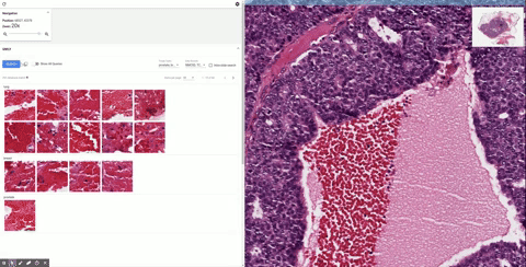 Google’s SMILY is reverse image search for cancer diagnosis